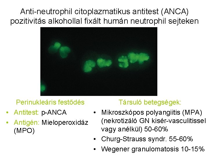 Anti-neutrophil citoplazmatikus antitest (ANCA) pozitivitás alkohollal fixált humán neutrophil sejteken Perinukleáris festődés Társuló betegségek: