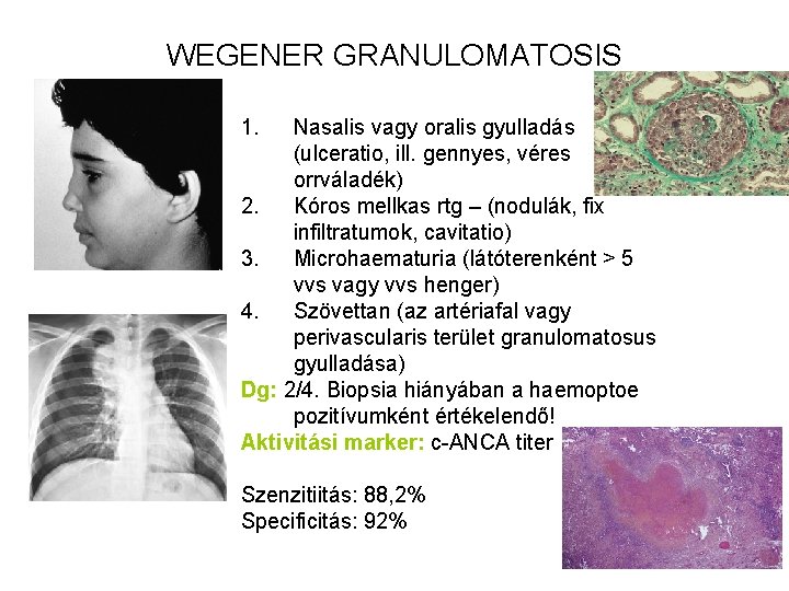 WEGENER GRANULOMATOSIS 1. Nasalis vagy oralis gyulladás (ulceratio, ill. gennyes, véres orrváladék) 2. Kóros