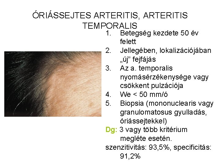 ÓRIÁSSEJTES ARTERITIS, ARTERITIS TEMPORALIS 1. Betegség kezdete 50 év felett 2. Jellegében, lokalizációjában „új”
