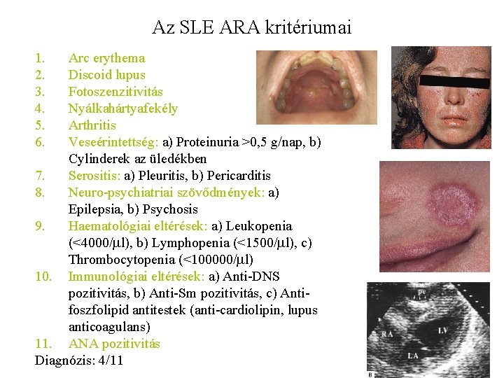 Az SLE ARA kritériumai 1. 2. 3. 4. 5. 6. Arc erythema Discoid lupus