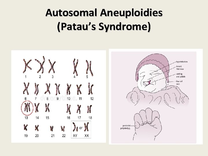 Autosomal Aneuploidies (Patau’s Syndrome) Autosomal Aneuploidies (Patau’s Syndrome)