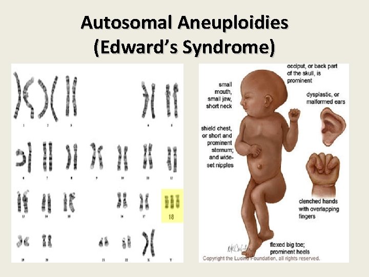 Autosomal Aneuploidies (Edward’s Syndrome) Autosomal Aneuploidies (Edward’s Syndrome)