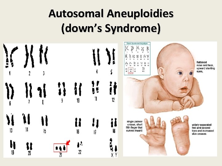 Autosomal Aneuploidies (down’s Syndrome) 