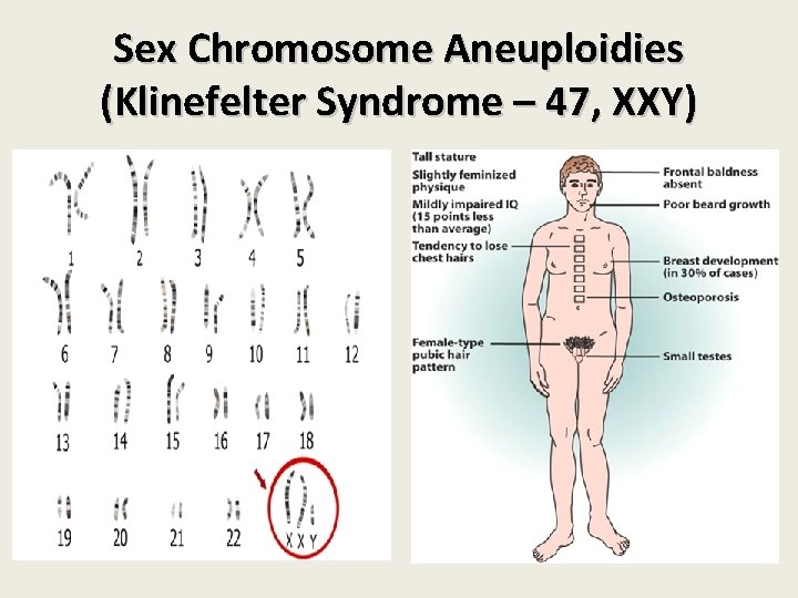 Sex Chromosome Aneuploidies (Klinefelter Syndrome – 47, XXY) Sex Chromosome Aneuploidies (Klinefelter Syndrome – 47, XXY)