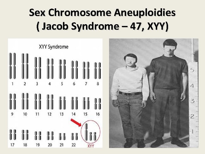 Sex Chromosome Aneuploidies ( Jacob Syndrome – 47, XYY) 