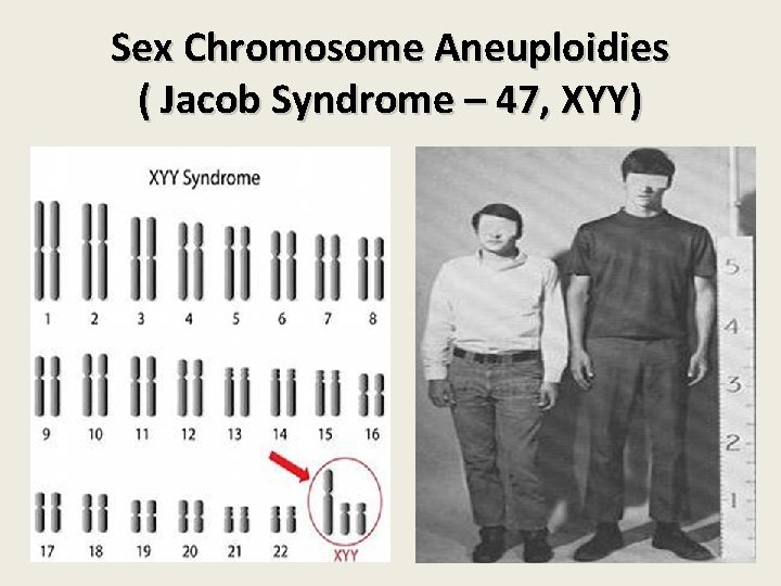 Sex Chromosome Aneuploidies ( Jacob Syndrome – 47, XYY) Sex Chromosome Aneuploidies ( Jacob Syndrome – 47, XYY)
