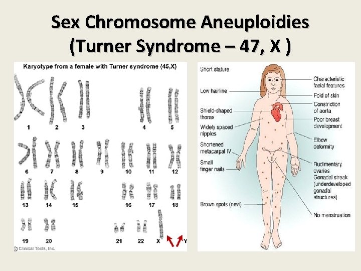 Sex Chromosome Aneuploidies (Turner Syndrome – 47, X ) 