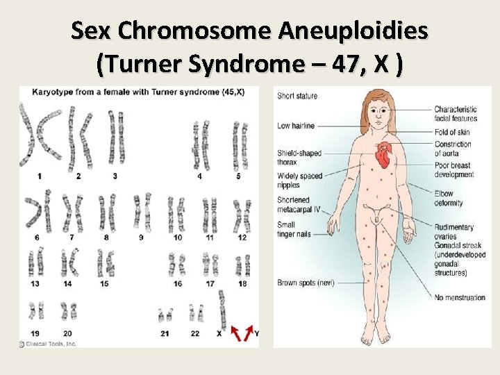 Sex Chromosome Aneuploidies (Turner Syndrome – 47, X ) Sex Chromosome Aneuploidies (Turner Syndrome – 47, X )
