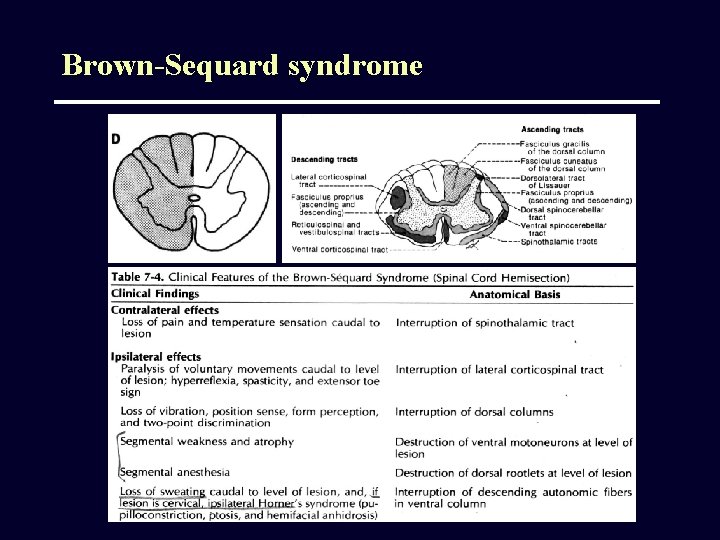 Brown-Sequard syndrome 