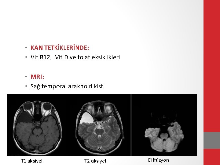  • KAN TETKİKLERİNDE: • Vit B 12, Vit D ve folat eksiklikleri •