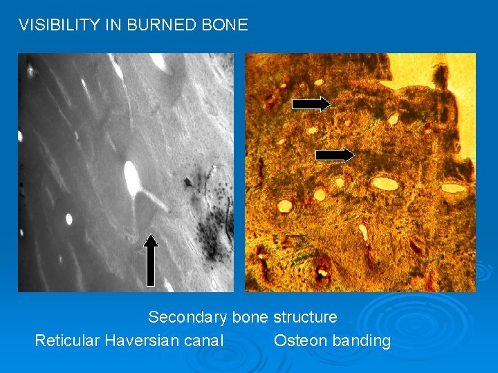 VISIBILITY IN BURNED BONE Secondary bone structure Reticular Haversian canal Osteon banding 