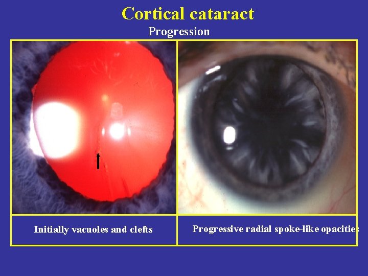 Cortical cataract Progression Initially vacuoles and clefts Progressive radial spoke-like opacities 