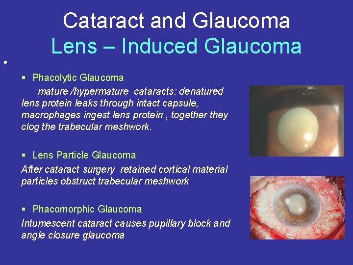  • Cataract and Glaucoma Lens – Induced Glaucoma § Phacolytic Glaucoma mature /hypermature