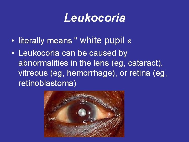 Leukocoria • literally means " white pupil « • Leukocoria can be caused by