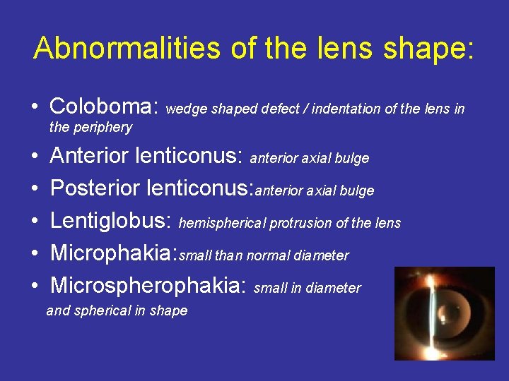 Abnormalities of the lens shape: • Coloboma: wedge shaped defect / indentation of the