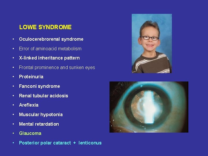 LOWE SYNDROME • Oculocerebrorenal syndrome • Error of aminoacid metabolism • X-linked inheritance pattern
