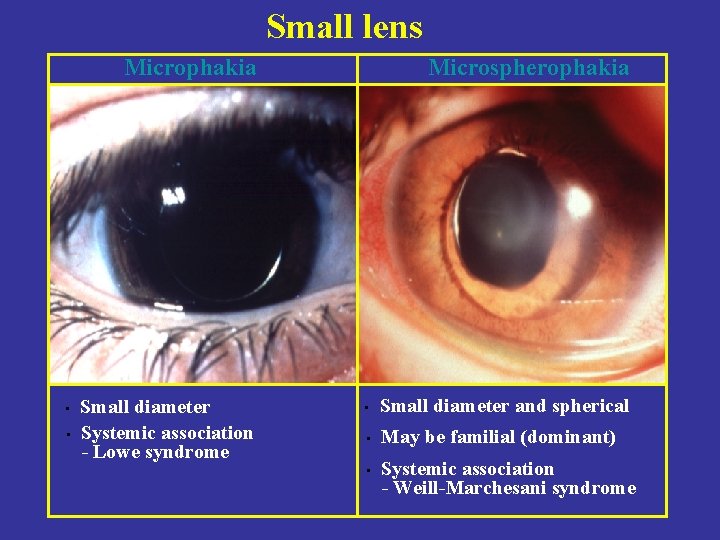 Small lens Microphakia • • Small diameter Systemic association - Lowe syndrome Microspherophakia •