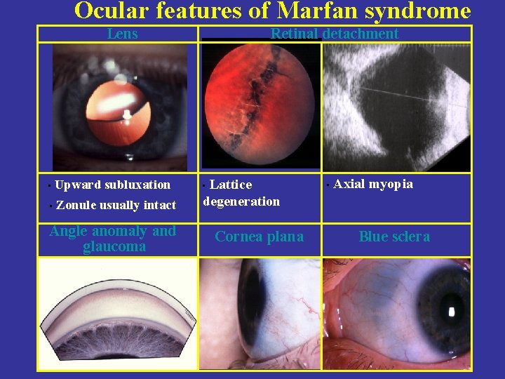 Ocular features of Marfan syndrome Lens • Upward subluxation • Zonule usually intact Angle