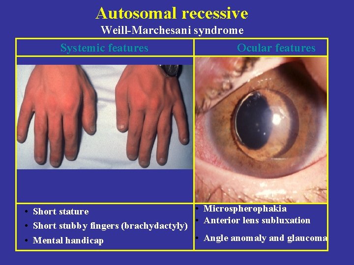 Autosomal recessive Weill-Marchesani syndrome Systemic features Ocular features • Microspherophakia • Short stature •