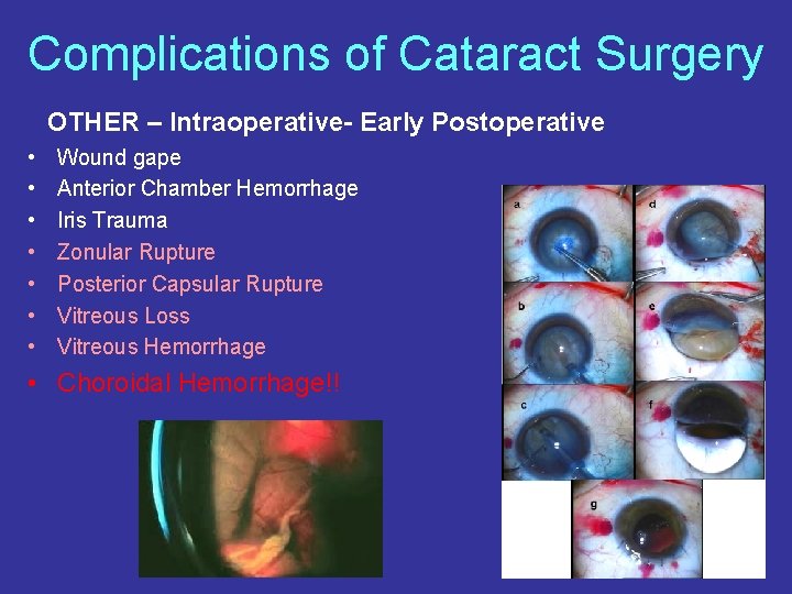 Complications of Cataract Surgery OTHER – Intraoperative- Early Postoperative • • Wound gape Anterior