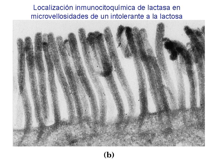 Localización inmunocitoquímica de lactasa en microvellosidades de un intolerante a la lactosa 