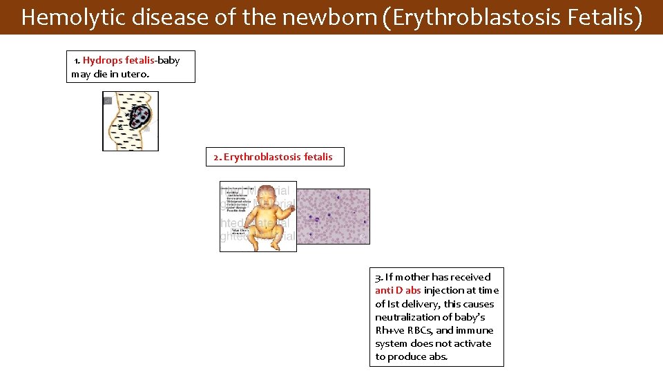 Hemolytic disease of the newborn (Erythroblastosis Fetalis) 1. Hydrops fetalis-baby may die in utero.