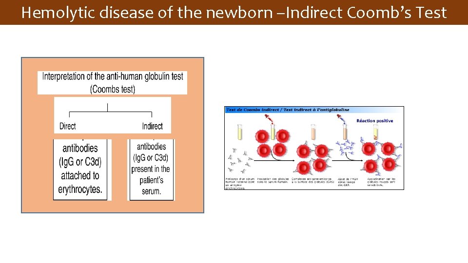 Hemolytic disease of the newborn –Indirect Coomb’s Test 