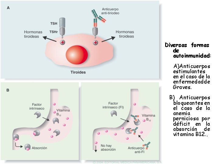 Diversas formas de autoinmunidad: A)Anticuerpos estimulantes en el caso de la enfermedadde Graves. B)