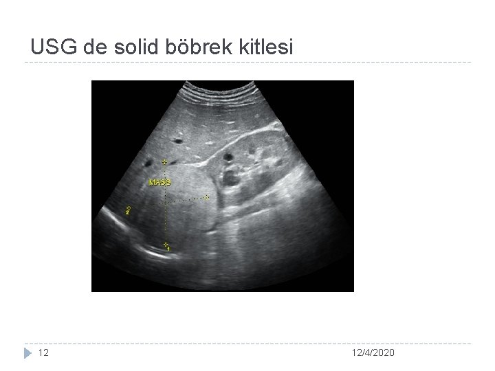 USG de solid böbrek kitlesi 12 12/4/2020 