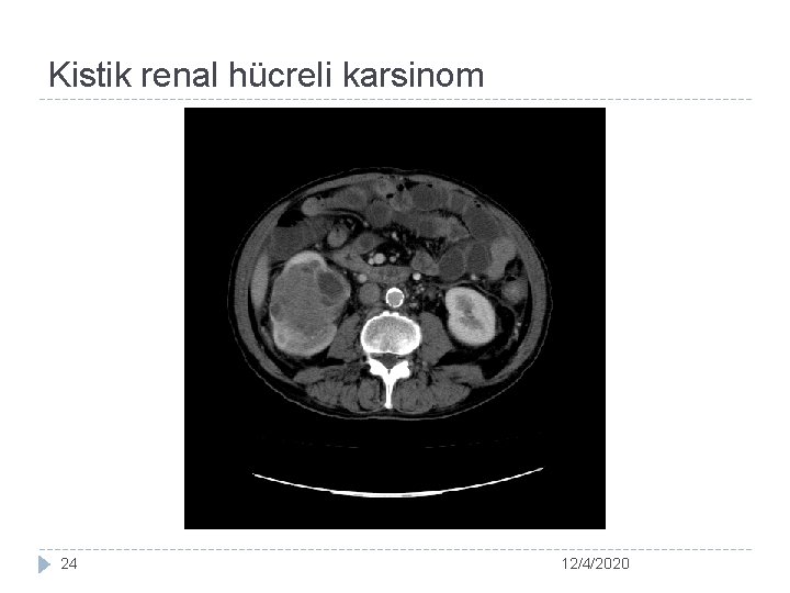 Kistik renal hücreli karsinom 24 12/4/2020 