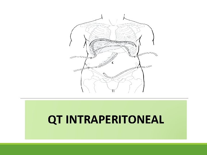 QT INTRAPERITONEAL 