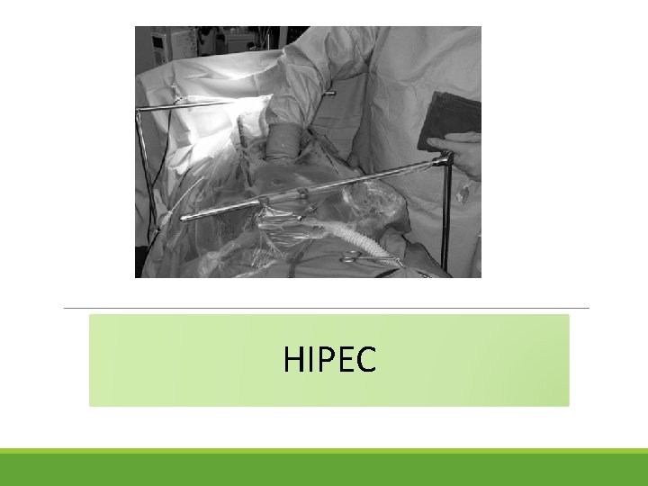 HIPEC 