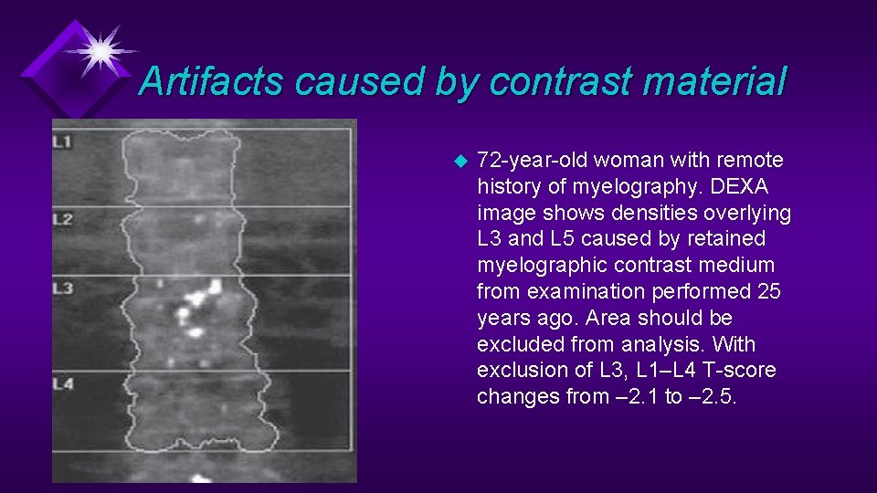 Artifacts caused by contrast material u 72 -year-old woman with remote history of myelography.