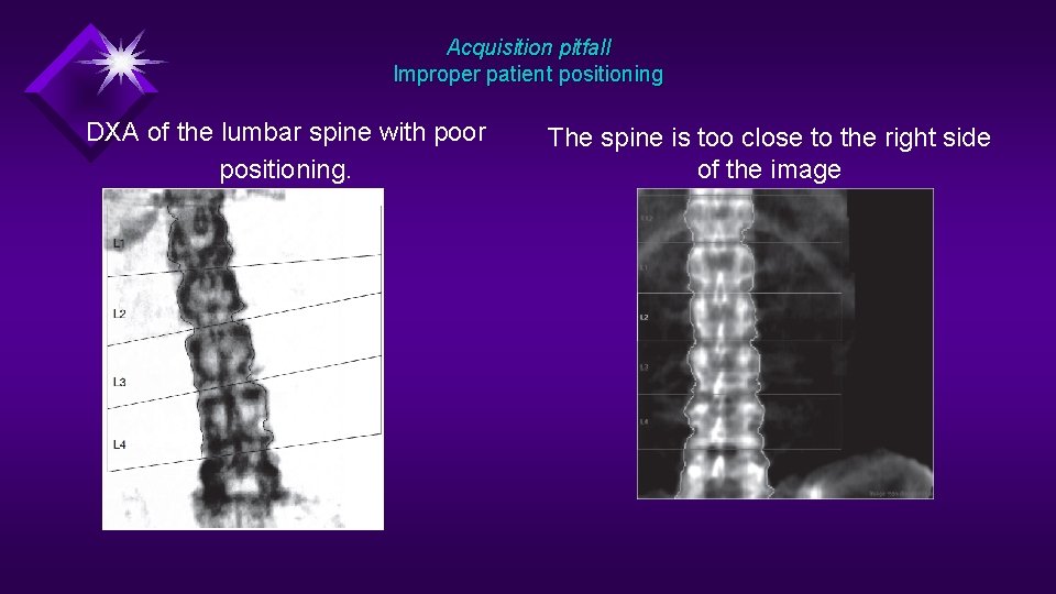 Acquisition pitfall Improper patient positioning DXA of the lumbar spine with poor positioning. The