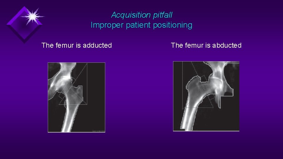 Acquisition pitfall Improper patient positioning The femur is adducted The femur is abducted 