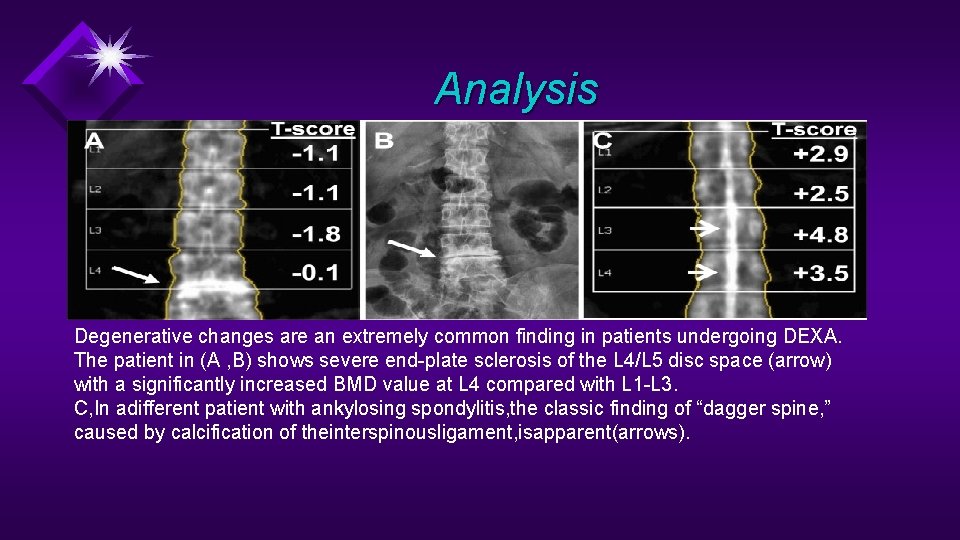 Analysis Degenerative changes are an extremely common finding in patients undergoing DEXA. The patient