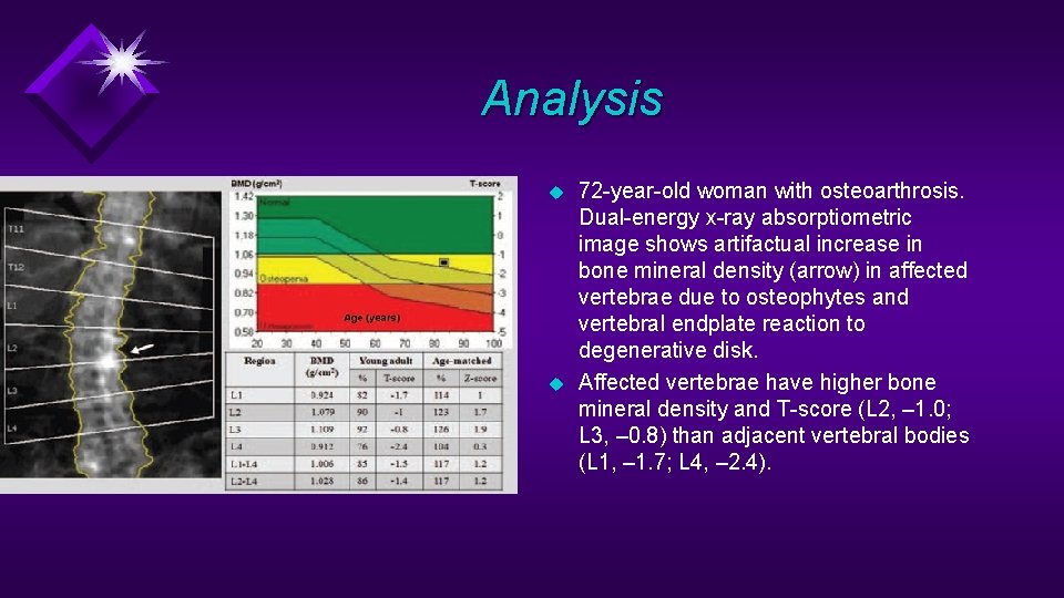 Analysis u u 72 -year-old woman with osteoarthrosis. Dual-energy x-ray absorptiometric image shows artifactual