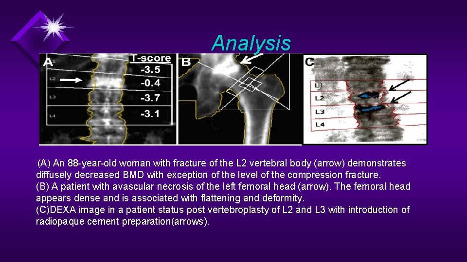 Analysis (A) An 88 -year-old woman with fracture of the L 2 vertebral body