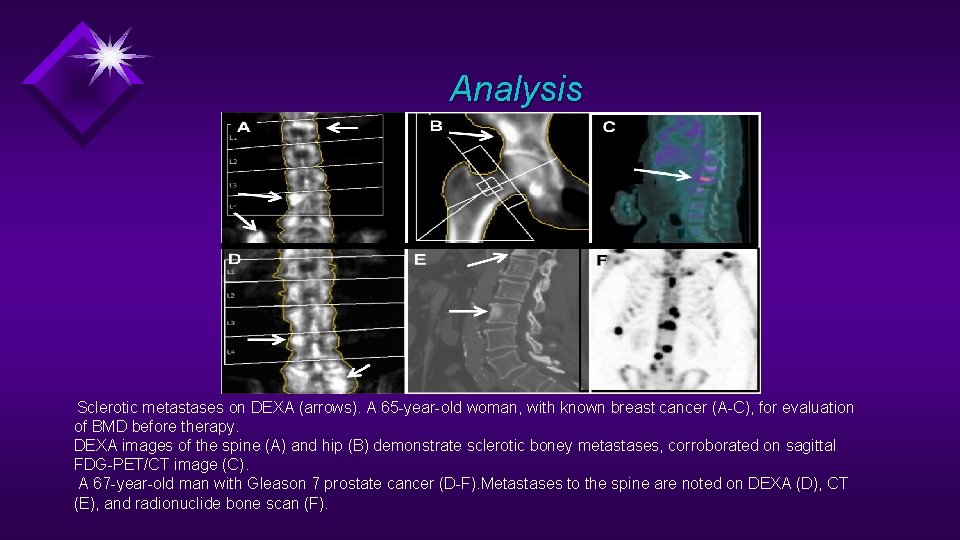 Analysis Sclerotic metastases on DEXA (arrows). A 65 -year-old woman, with known breast cancer