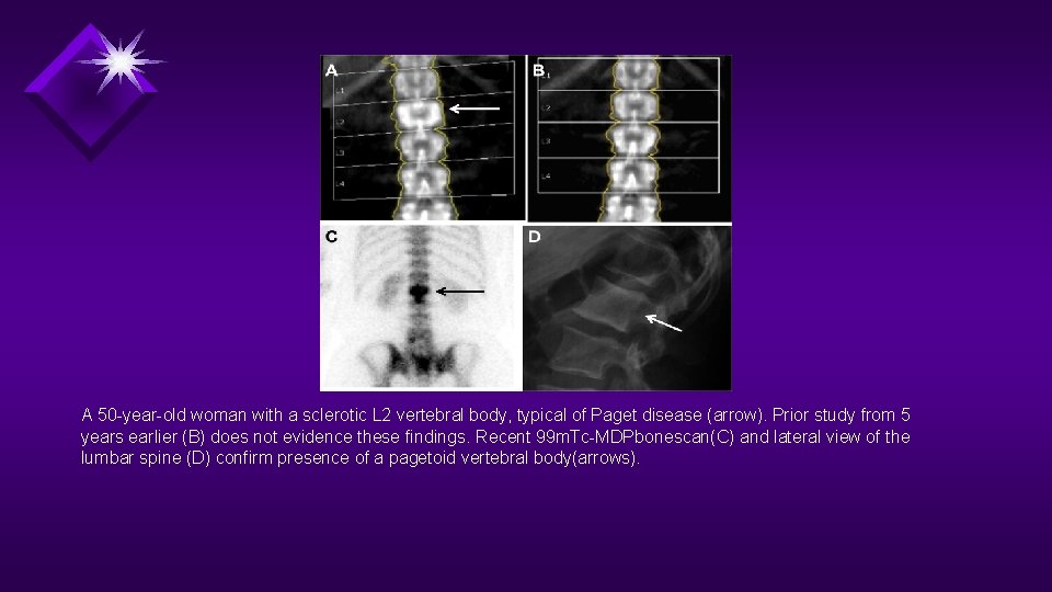 A 50 -year-old woman with a sclerotic L 2 vertebral body, typical of Paget