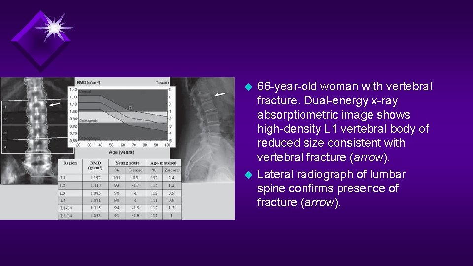 u u 66 -year-old woman with vertebral fracture. Dual-energy x-ray absorptiometric image shows high-density