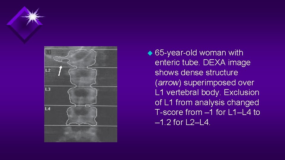 u 65 -year-old woman with enteric tube. DEXA image shows dense structure (arrow) superimposed