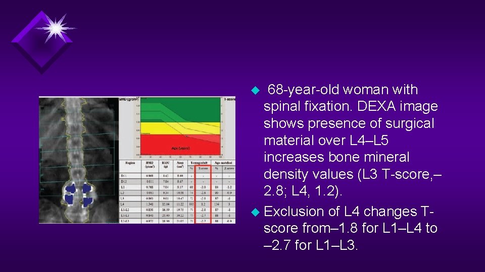 u 68 -year-old woman with spinal fixation. DEXA image shows presence of surgical material