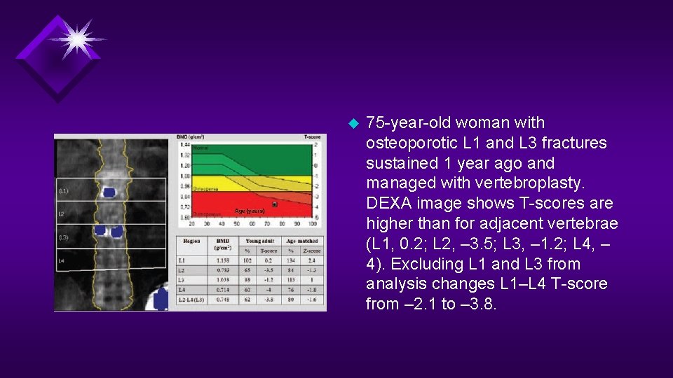 u 75 -year-old woman with osteoporotic L 1 and L 3 fractures sustained 1