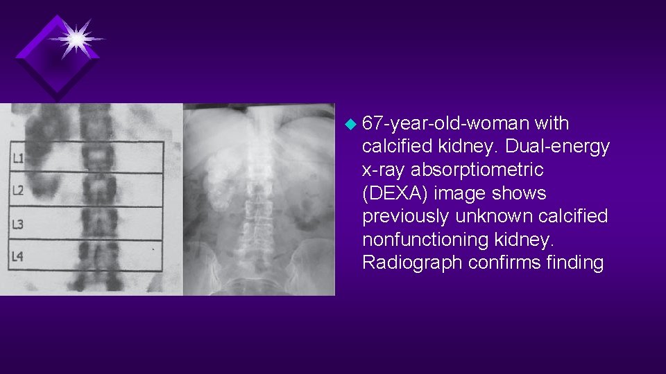 u 67 -year-old-woman with calcified kidney. Dual-energy x-ray absorptiometric (DEXA) image shows previously unknown