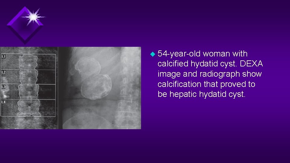 u 54 -year-old woman with calcified hydatid cyst. DEXA image and radiograph show calcification