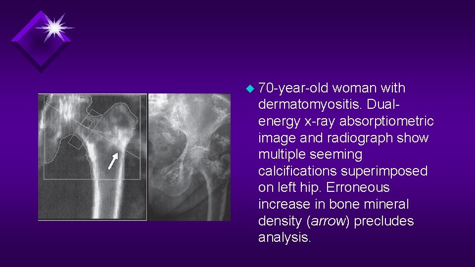 u 70 -year-old woman with dermatomyositis. Dualenergy x-ray absorptiometric image and radiograph show multiple