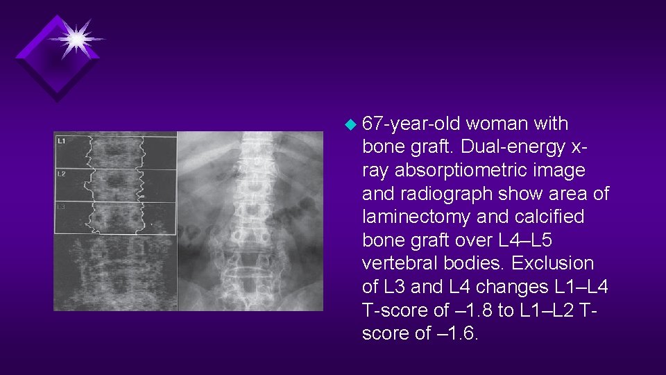 u 67 -year-old woman with bone graft. Dual-energy xray absorptiometric image and radiograph show u 67 -year-old woman with bone graft. Dual-energy xray absorptiometric image and radiograph show