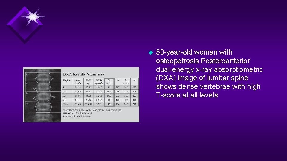 u 50 -year-old woman with osteopetrosis. Posteroanterior dual-energy x-ray absorptiometric (DXA) image of lumbar