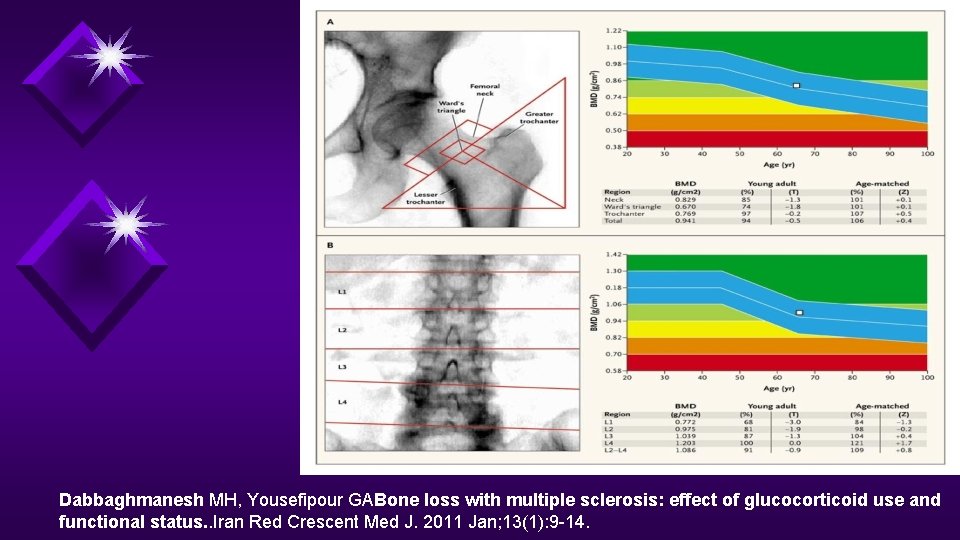 Dabbaghmanesh MH, Yousefipour GABone loss with multiple sclerosis: effect of glucocorticoid use and functional